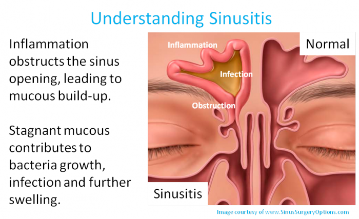 Understanding Sinusitis