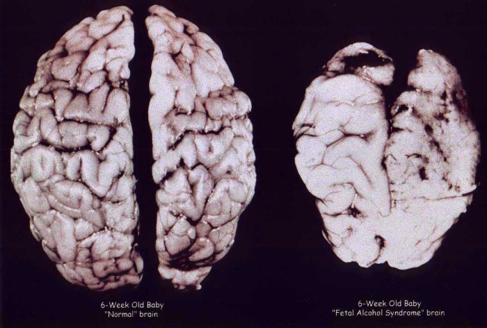 Fetal Alcohol Syndrome.jpg