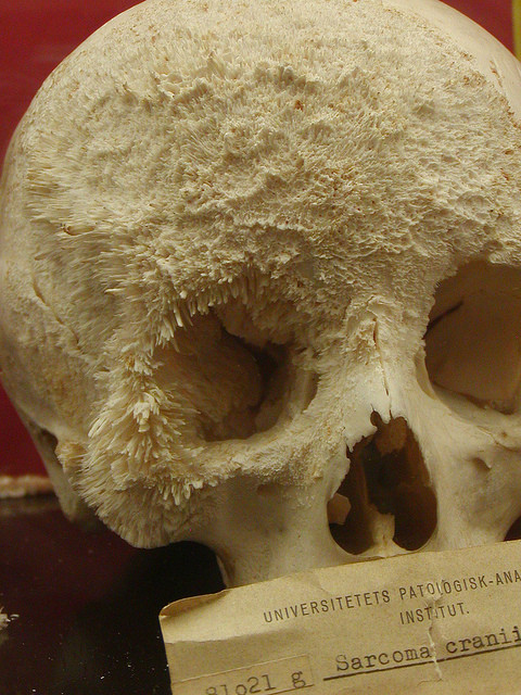 skull_cancer.jpg (135 KB)